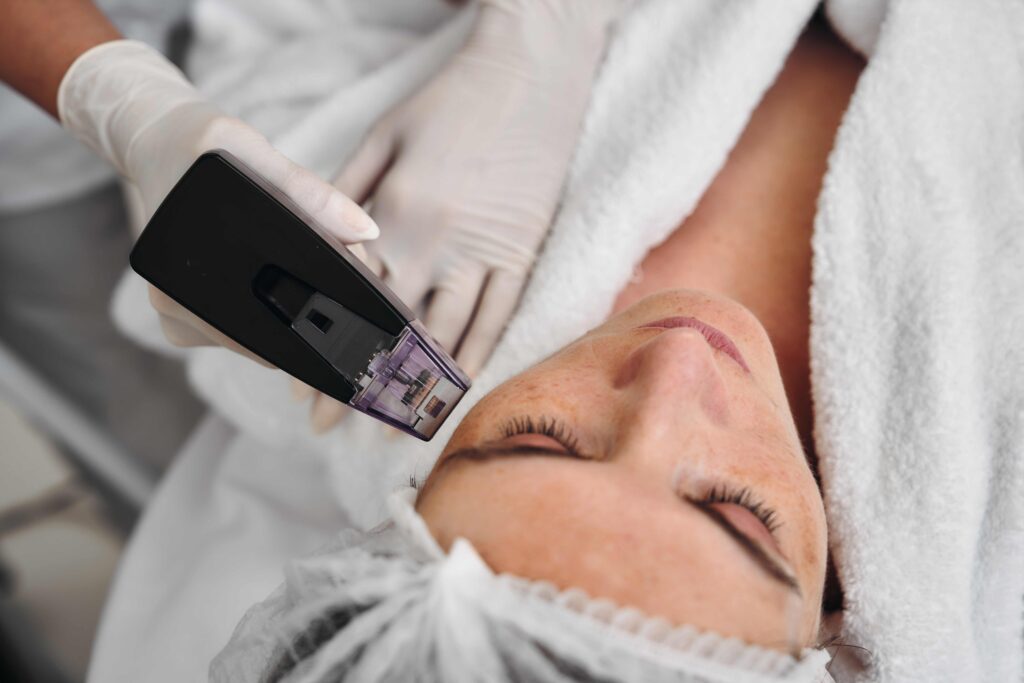 Radiofrequency Skin Needling | The Best for Rejuvenated Skin